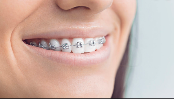 IMPORTANCE OF TEETH BRACES