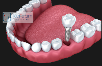 Benefits of dental implants