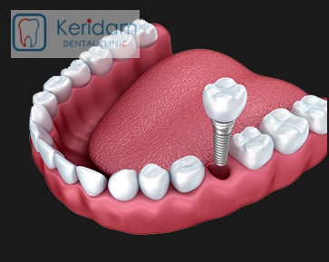 Benefits of Dental Implants for Kenyans